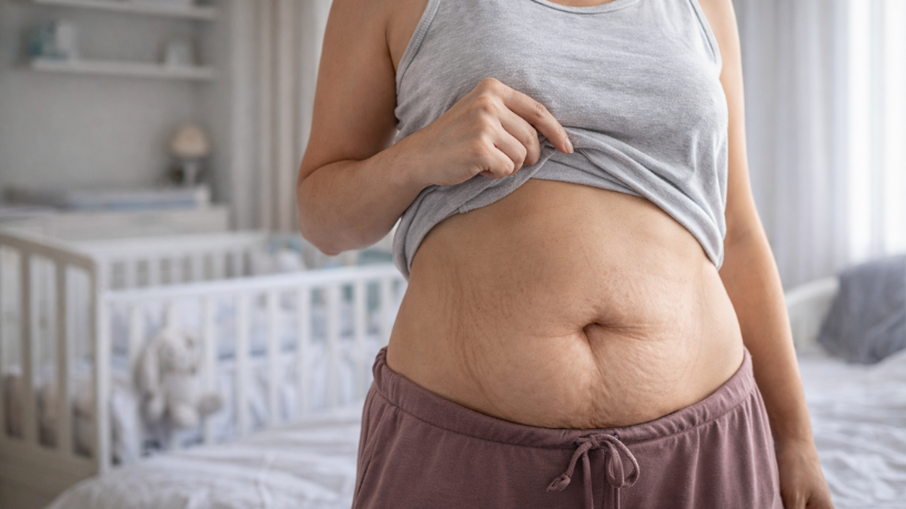 Haeckel Cabral Moraes explica que alterações teciduais da gestação influenciam o retorno ao padrão corporal anterior.